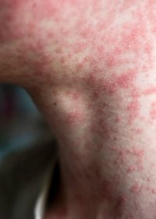 Sarampión: autoridades alertan por síntomas y refuerzan la vacunación